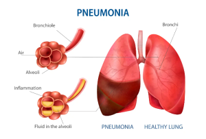 Inilah Beberapa Gejala Pneumonia Wajib di Waspadai